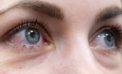 covid19 pinkeye Pink eye may be primary symptom of COVID-19