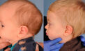 Virtual tools help surgeons correct skull defects in babies Virtual tools help surgeons correct skull defects in babies